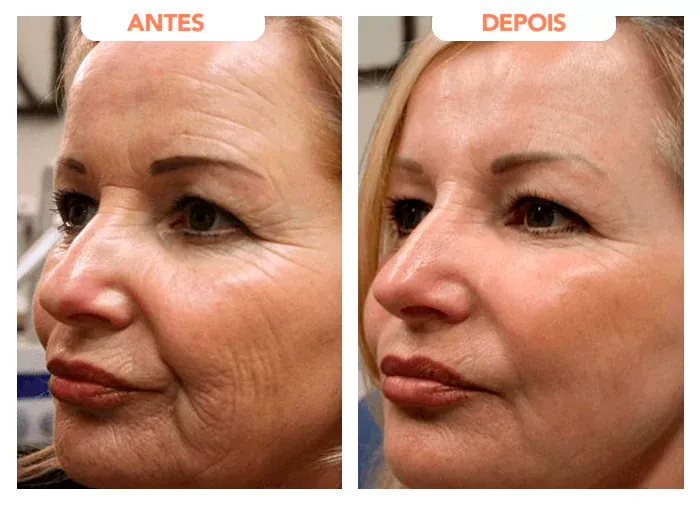 Trans Resveratrol Gotas- Imagem de antes e depois - percebesse uma grande diferença na pele