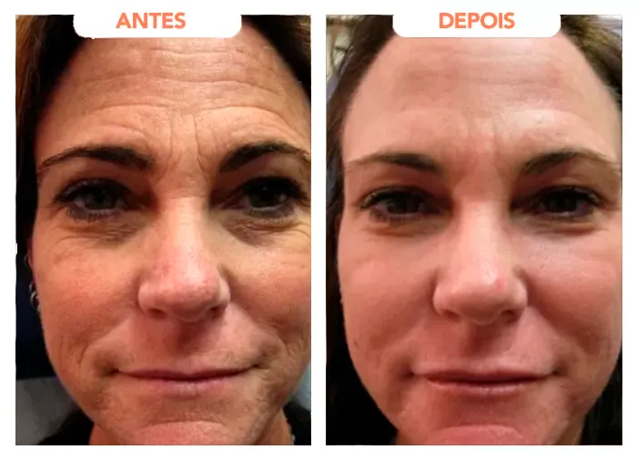 Trans Resveratrol Gotas- Imagem de antes e depois - percebesse uma grande diferença na pele