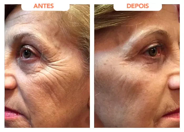 Trans Resveratrol Gotas- Imagem de antes e depois - percebesse uma grande diferença na pele