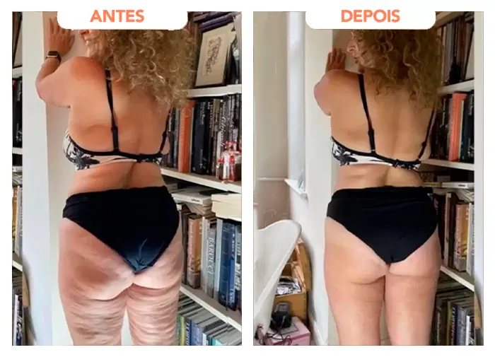 Trans Resveratrol Gotas- Imagem de antes e depois - percebesse uma grande diferença na pele