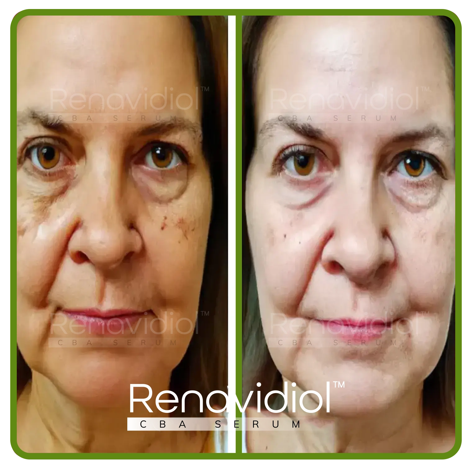 Imagem mostrando o uso antes e depois do Renavidiol 