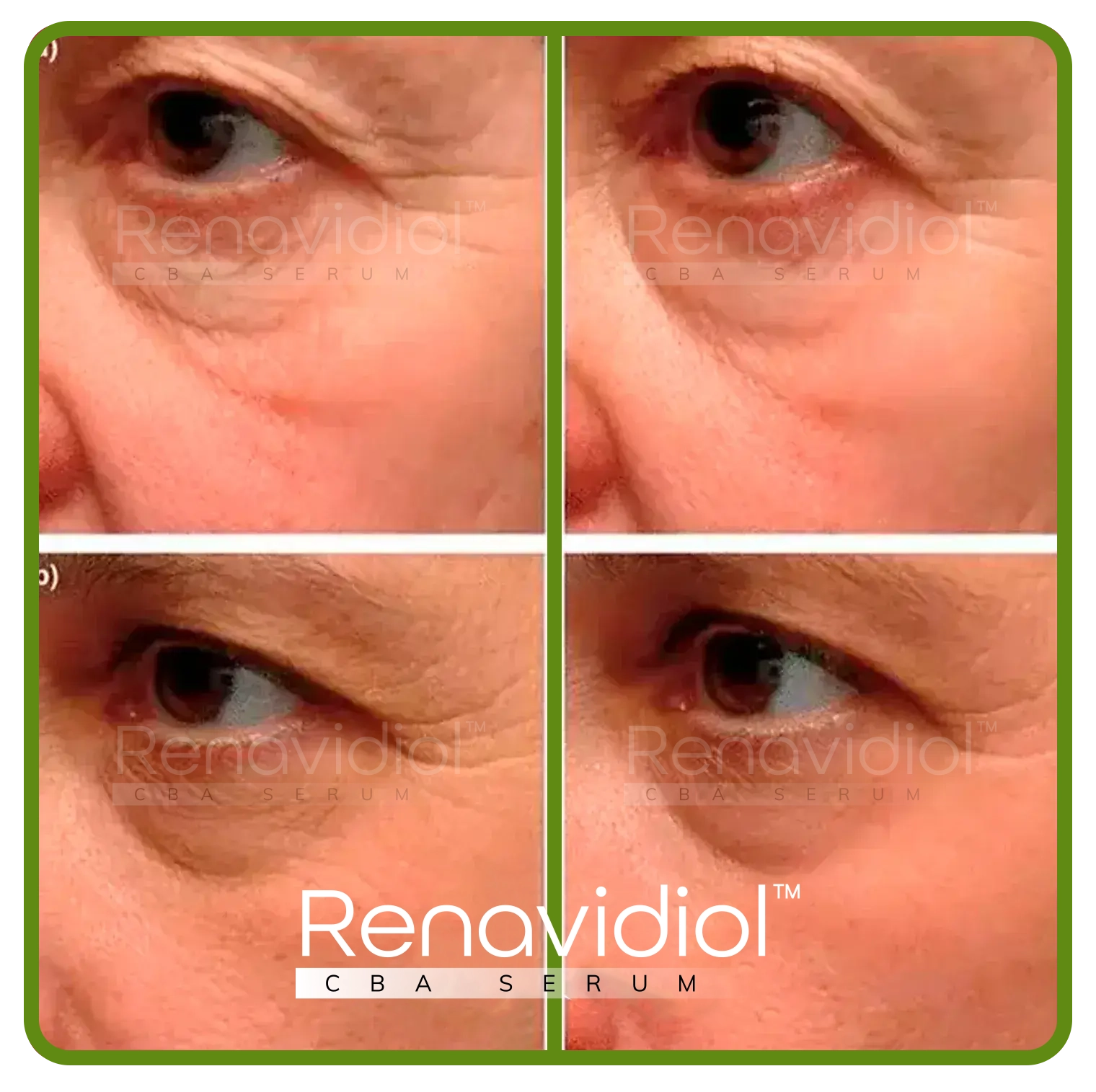 Imagem mostrando o uso antes e depois do Renavidiol 