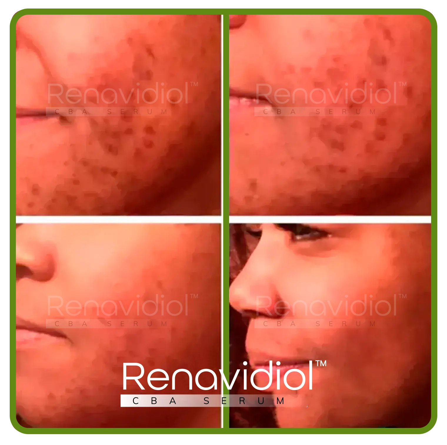 Imagem mostrando o uso antes e depois do Renavidiol 