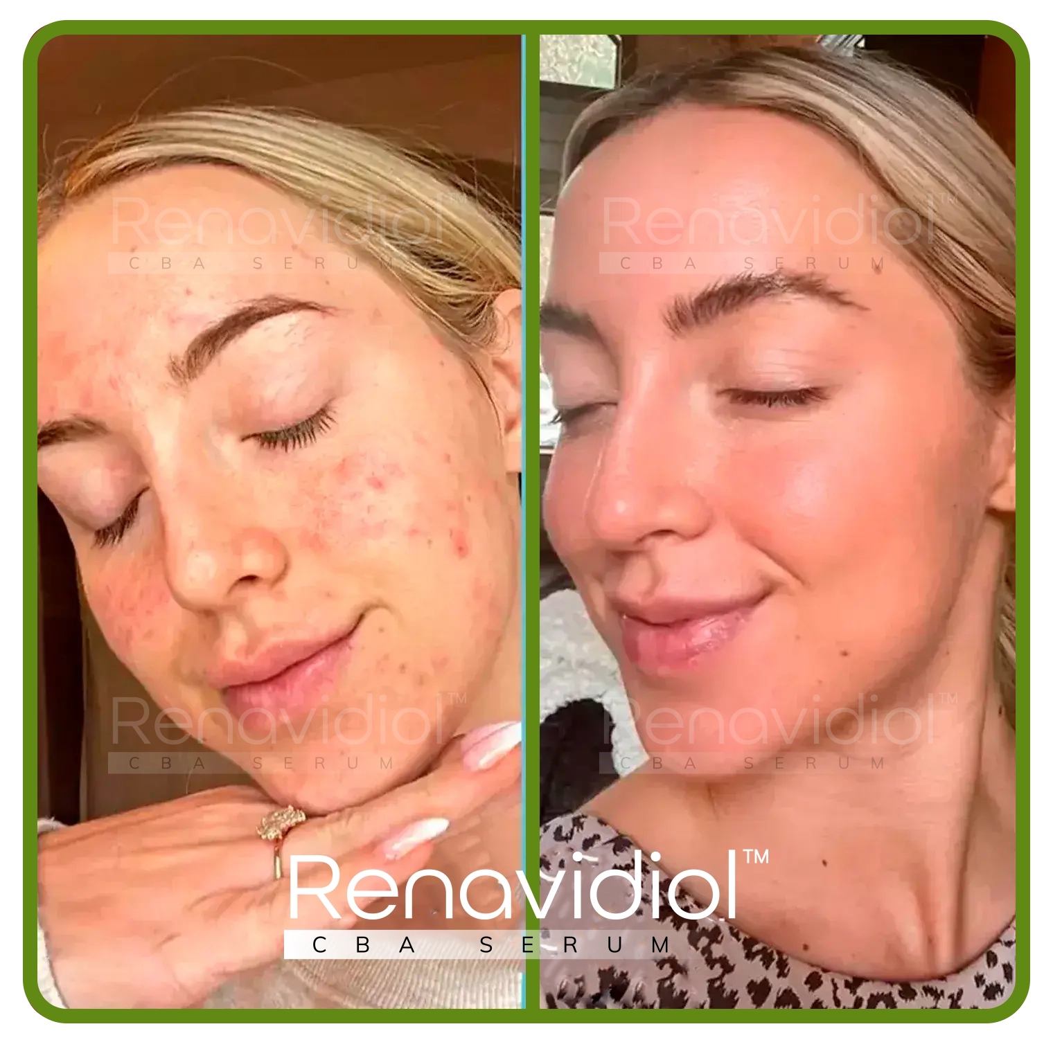 Imagem mostrando o uso antes e depois do Renavidiol 
