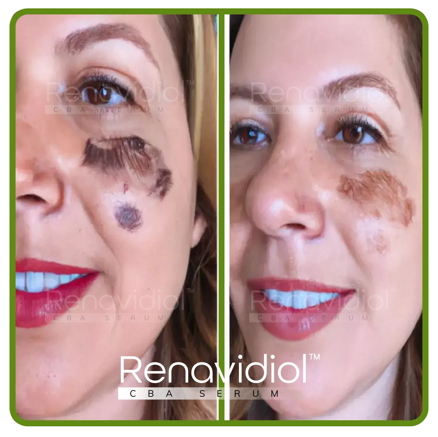 Imagem mostrando o uso antes e depois do Renavidiol 