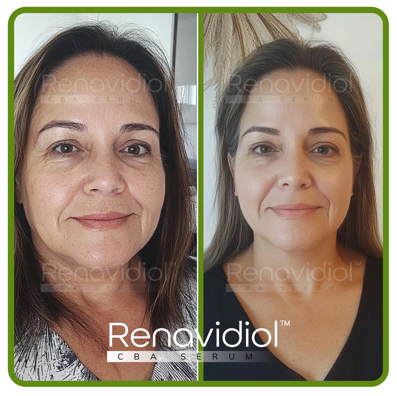 Imagem mostrando o uso antes e depois do Renavidiol 